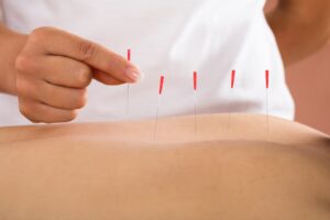 Dry needling treatment for scoliosis pain Manila