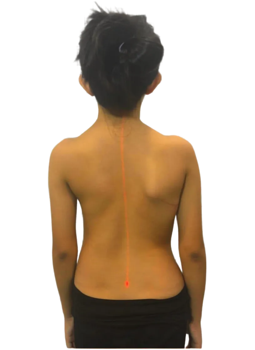 Back view of the same child showing straighter spine and improved posture with red laser alignment after scoliosis treatment.