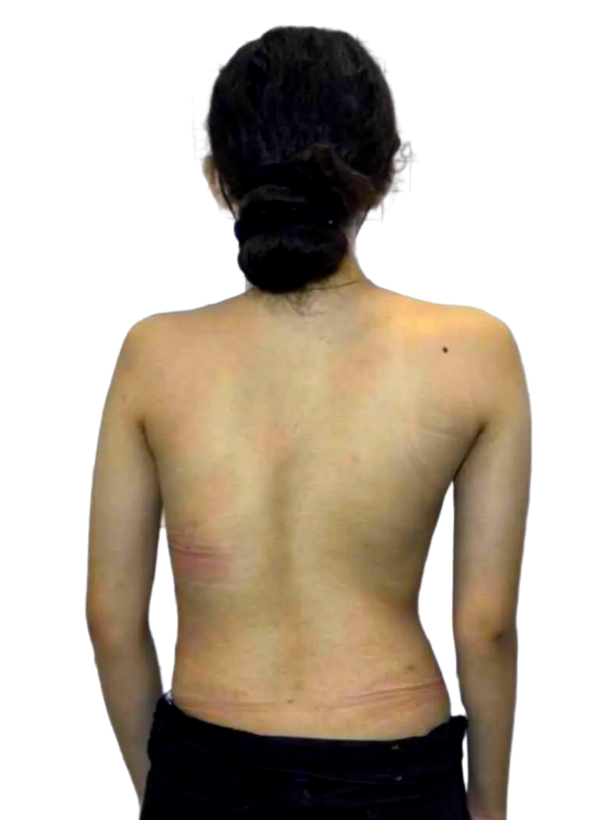 Back view of the same woman with improved spinal alignment and more balanced shoulders after scoliosis treatment.