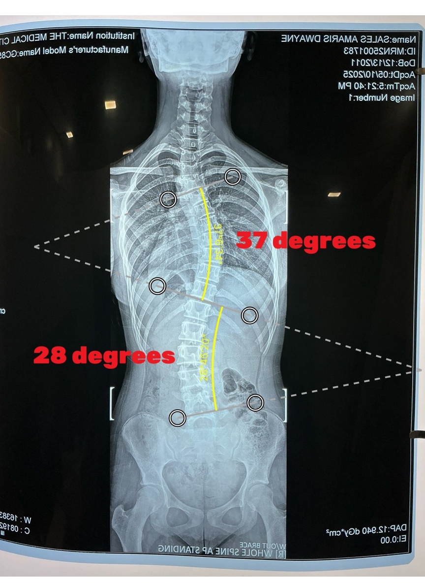 X-ray of a spine after scoliosis treatment showing improved alignment with a 37-degree thoracic curve and 28-degree lumbar curve.