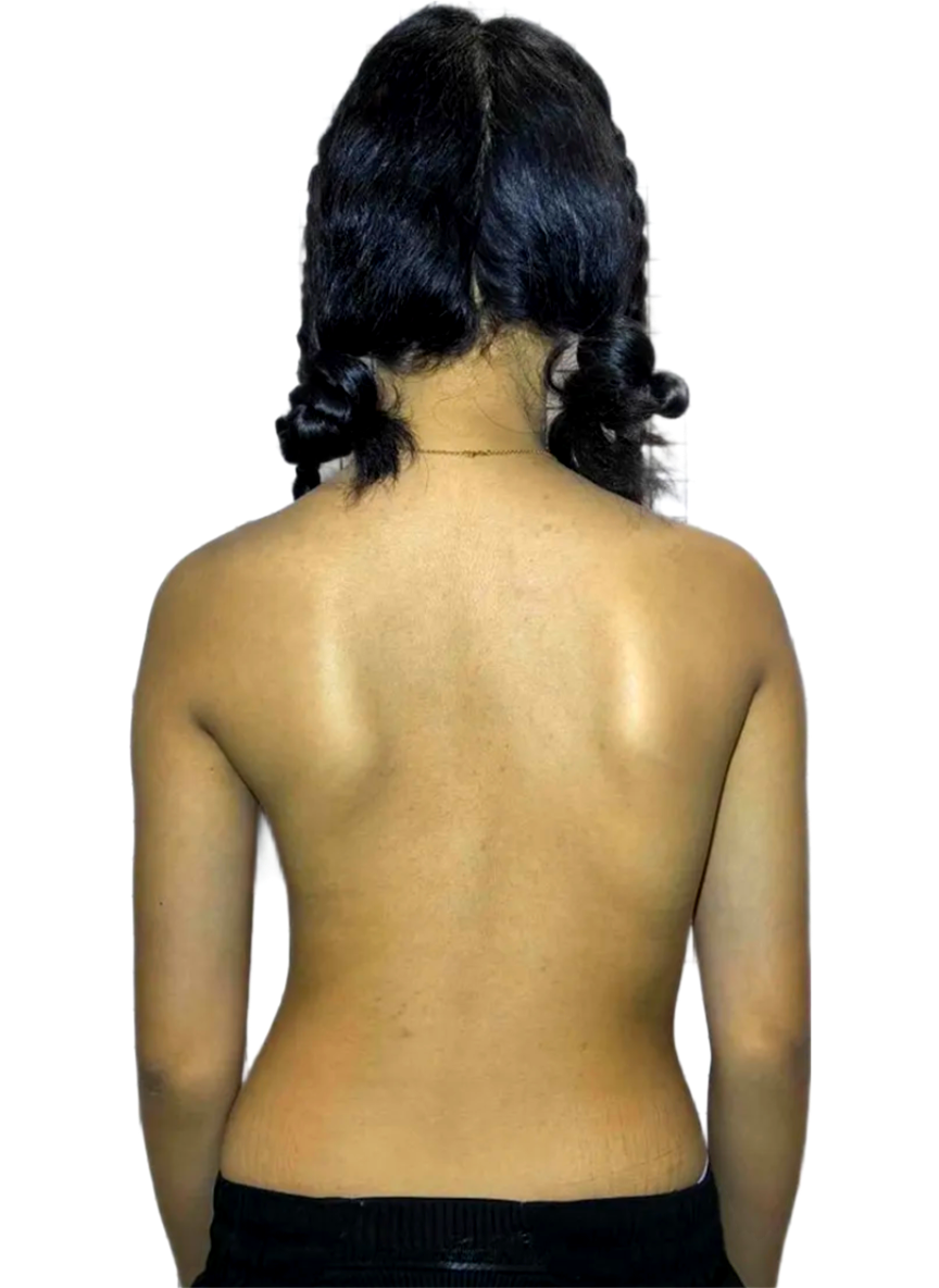 Back view of a young woman with more balanced shoulders and improved posture after scoliosis treatment.