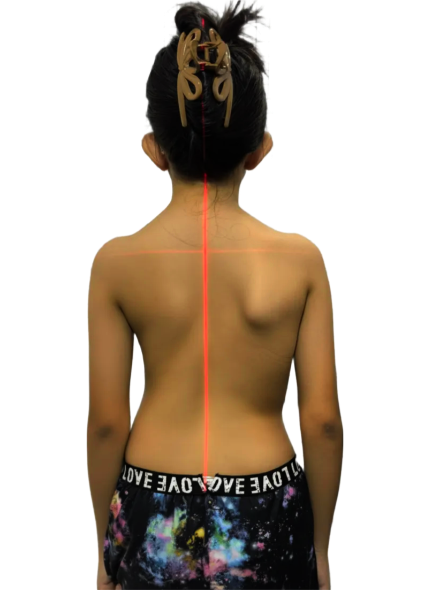 Back view of a child with scoliosis showing spinal curve and uneven alignment marked with red laser lines before treatment.