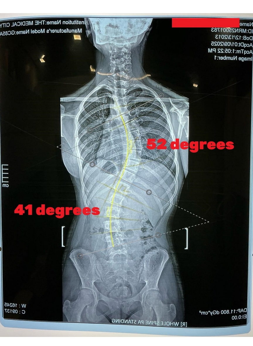 X-ray of a spine with severe scoliosis showing a 52-degree thoracic curve and 41-degree lumbar curve before treatment.
