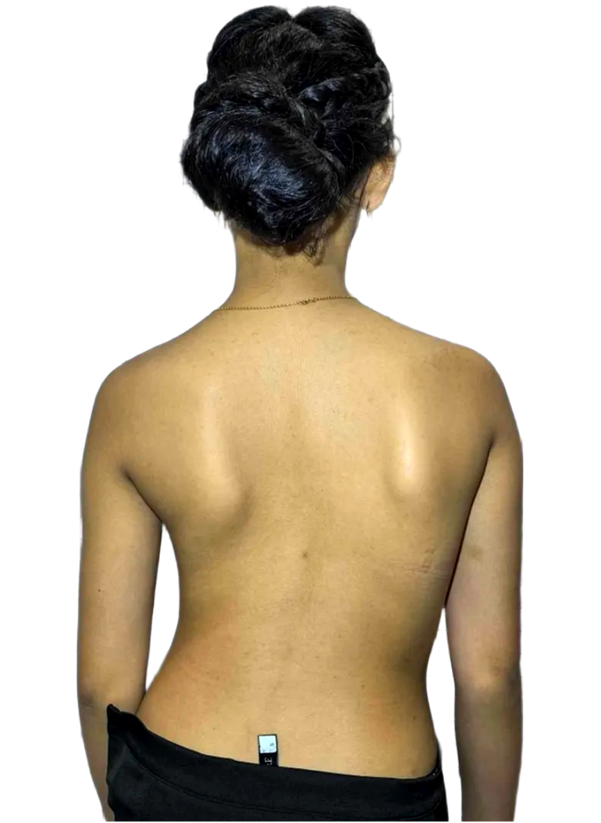 Back view of a young woman showing uneven shoulders and spinal imbalance before scoliosis treatment.