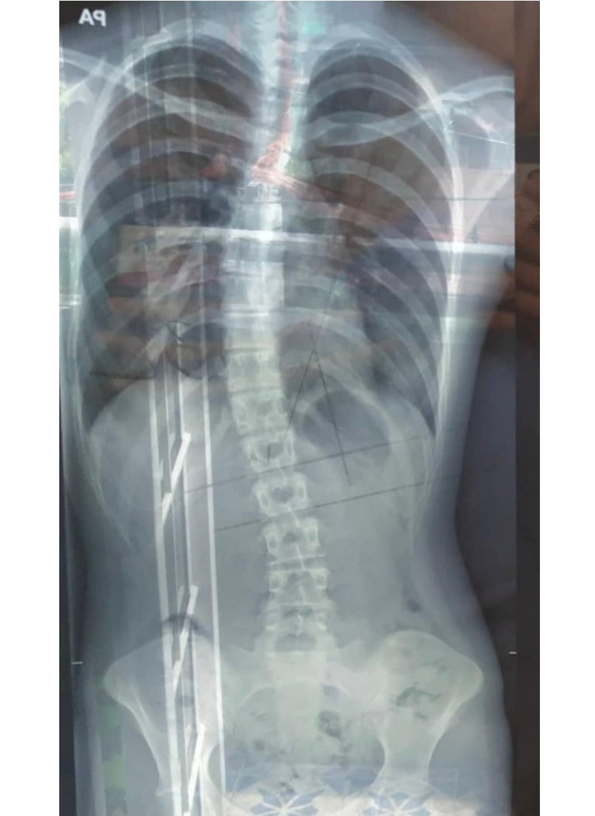 X-ray showing a curved spine before scoliosis treatment, highlighting spinal misalignment.