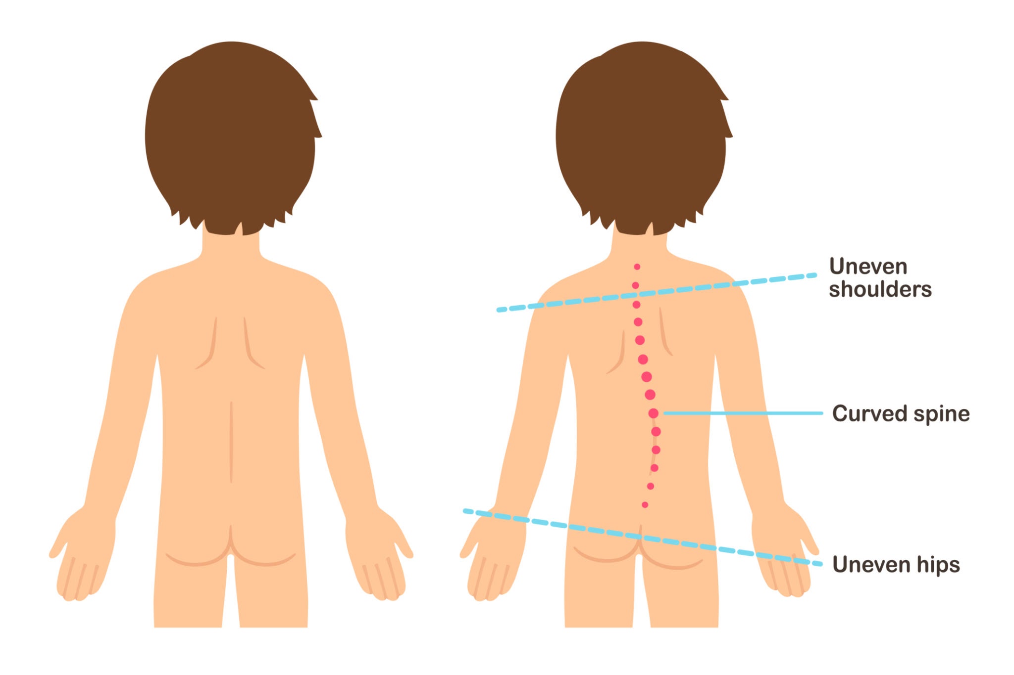non-surgical scoliosis treatment Makati